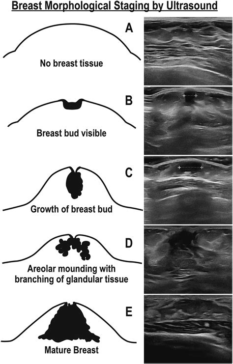 Breast Stages in Puberty .